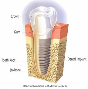 Image Source: http://www.napervillecosmeticdentistry.com/images/dental-implant-diagram.jpg