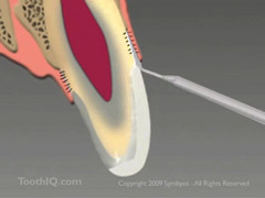 https://www.stevenleedds.com/images/fiberotomy.jpg