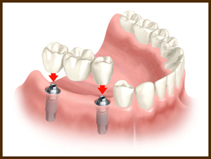 Image Source: http://www.signaturedentaloffice.com/images/implant-bridge.jpg