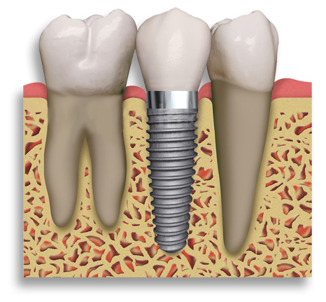 Image Source: http://lawilshireperio.com/yahoo_site_admin/assets/images/Dental_Implant_2_teeth.204153719_std.jpg