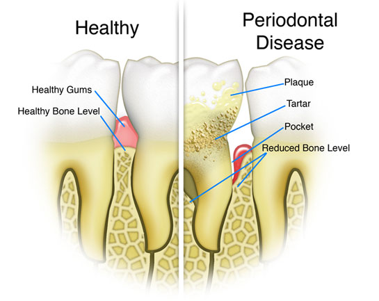 Image Source: http://c1-preview.prosites.com/temp2bf55j3398/wy/images/periodontal-disease.jpg