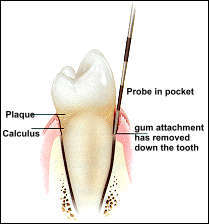 Image Source: http://www.dentalspecialty.com/images/periodontics_4.jpg