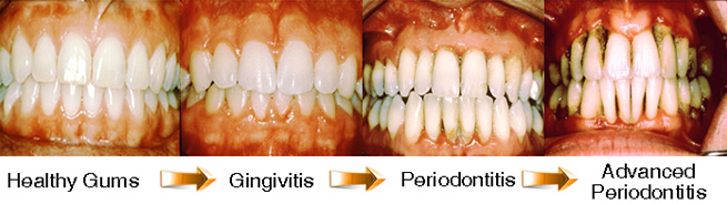 Image Source: http://199.21.203.9/wp-content/uploads/2011/11/stages-of-gum-disease.jpg